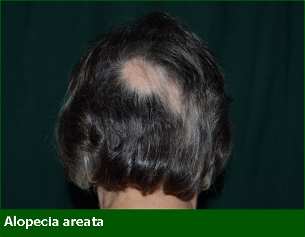 Alopecia Areata - Professione Farmacia