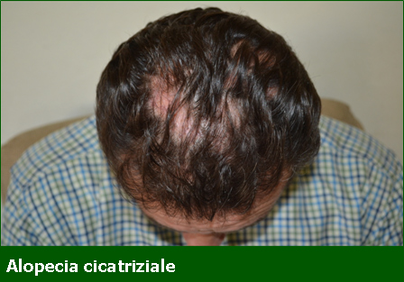 Alopecia Cicatriziale - Professione Farmacia