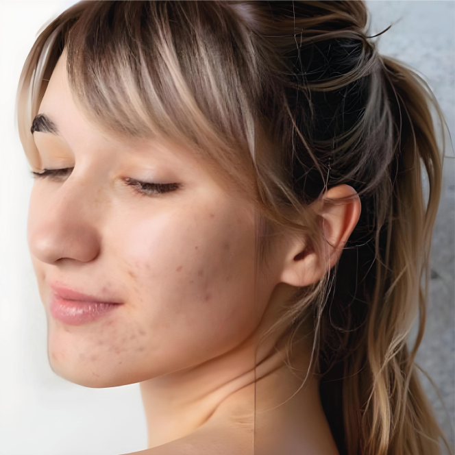 Acne-Cause-Trattamenti-Farmacologici-Professione-Farmacia